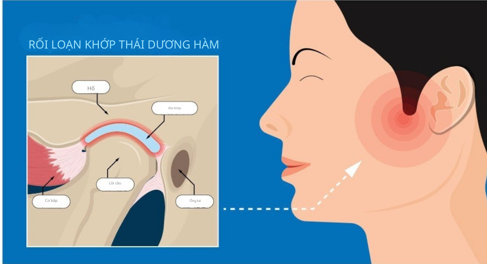 Rối loạn khớp thái dương hàm