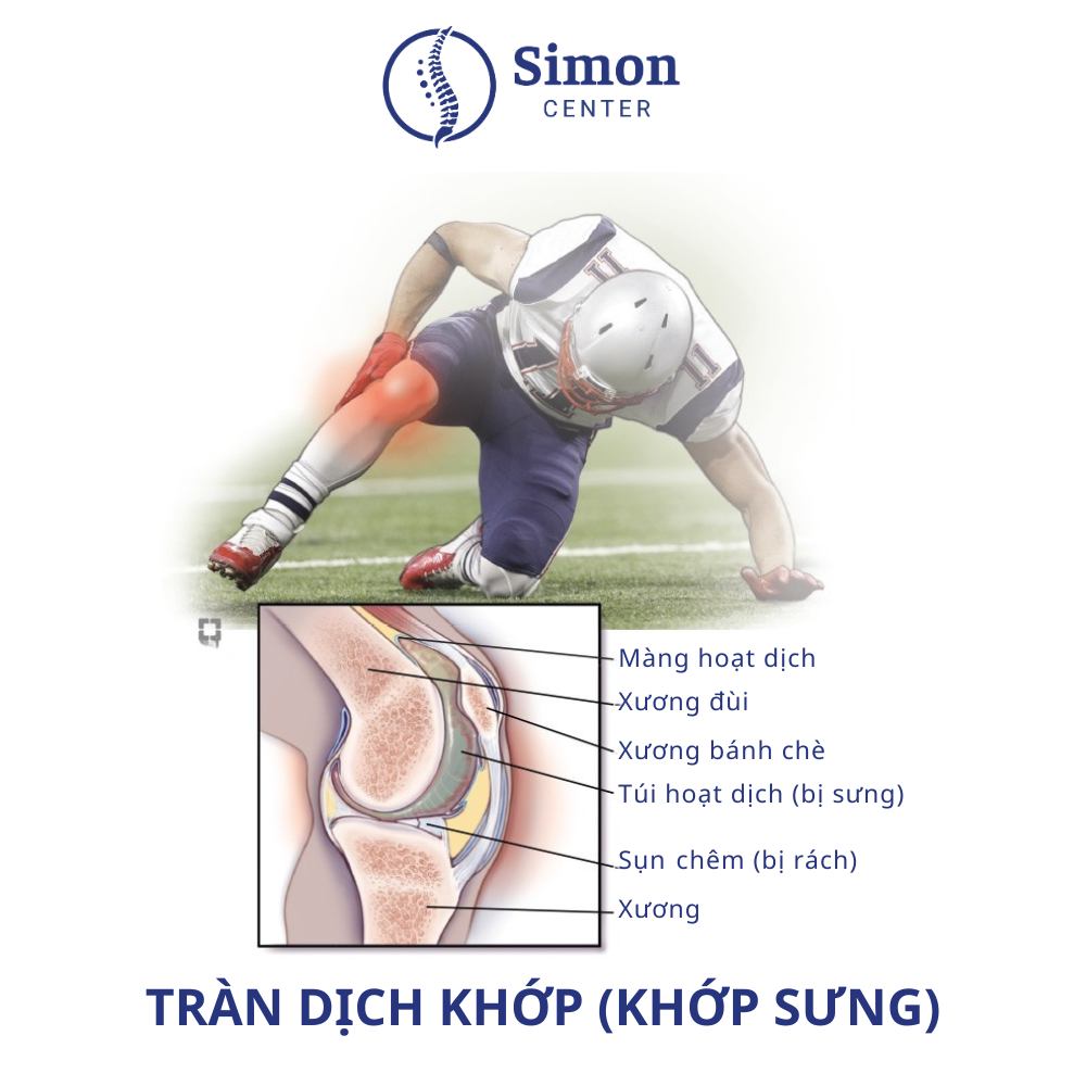 Tràn dịch khớp