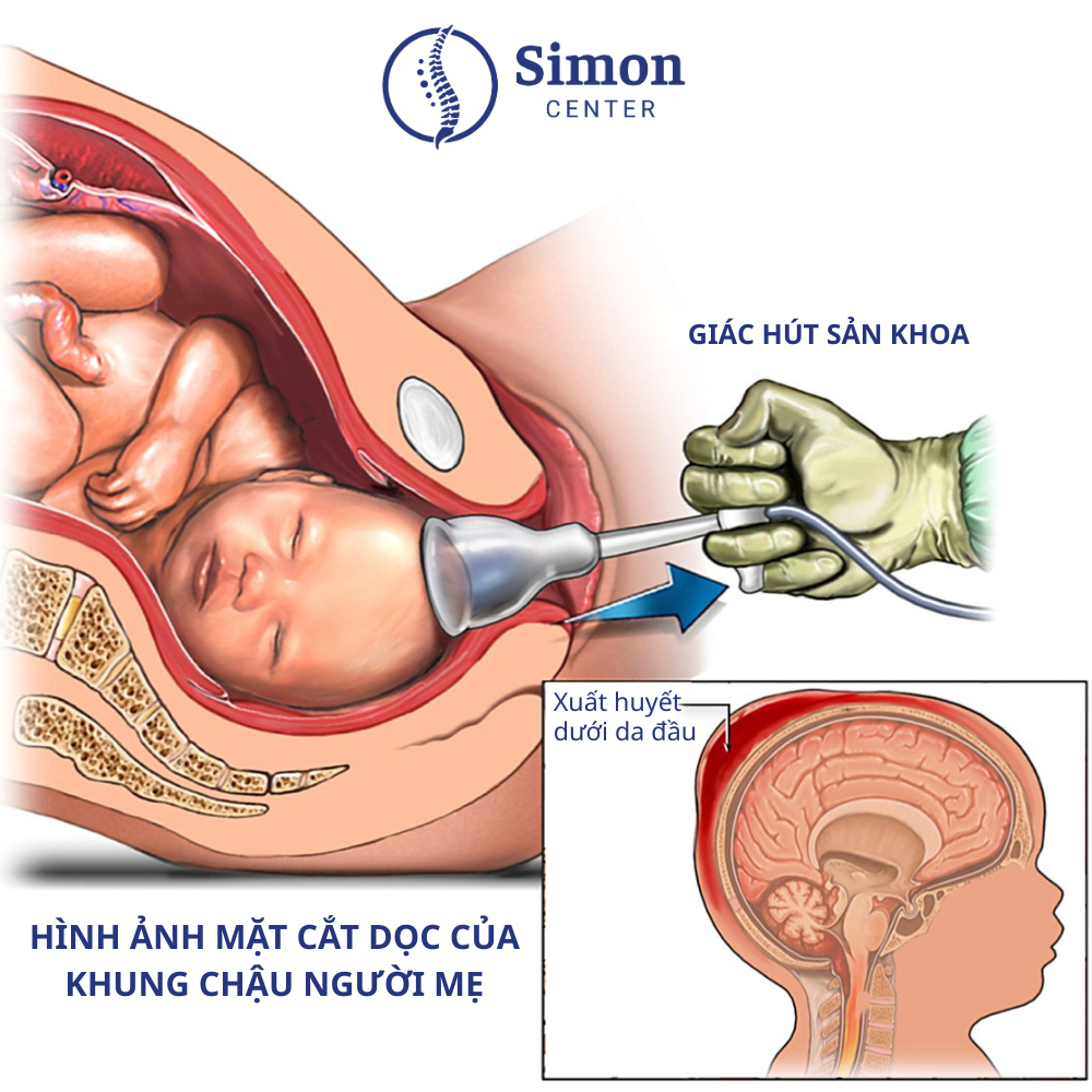 Trẻ chậm nói, chậm vận động do sai lệch cột sống & sang chấn khi sinh