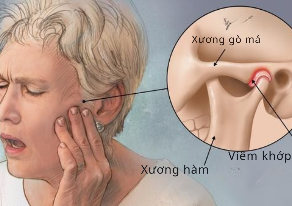 Rối loạn khớp thái dương hàm là gì?