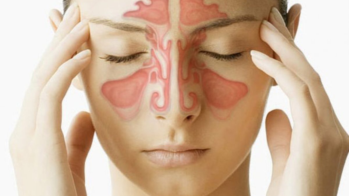 viêm xoang mãn tính viêm mũi dị ứng