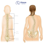 Cong vẹo cột sống